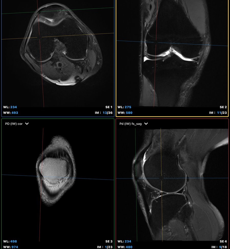 3T 膝 MRI 四分割影像示例