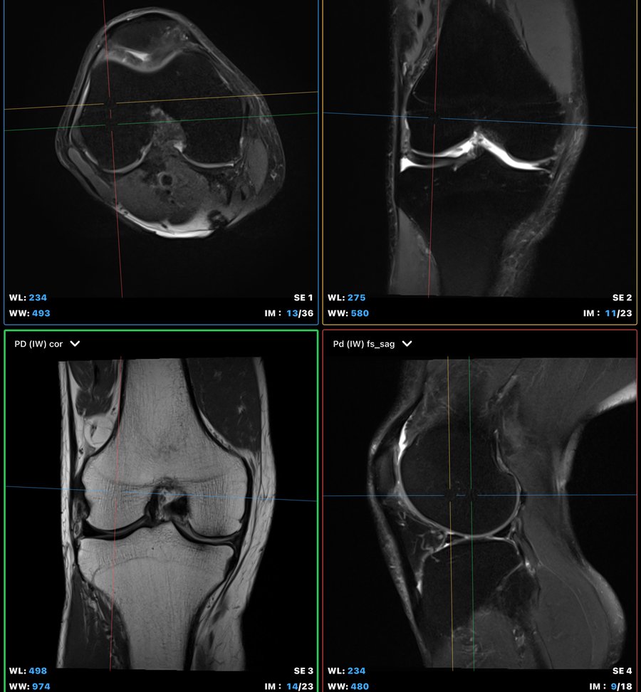 膝 MRI 所見與後續路徑規劃